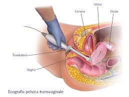 Ecografia Pelvica